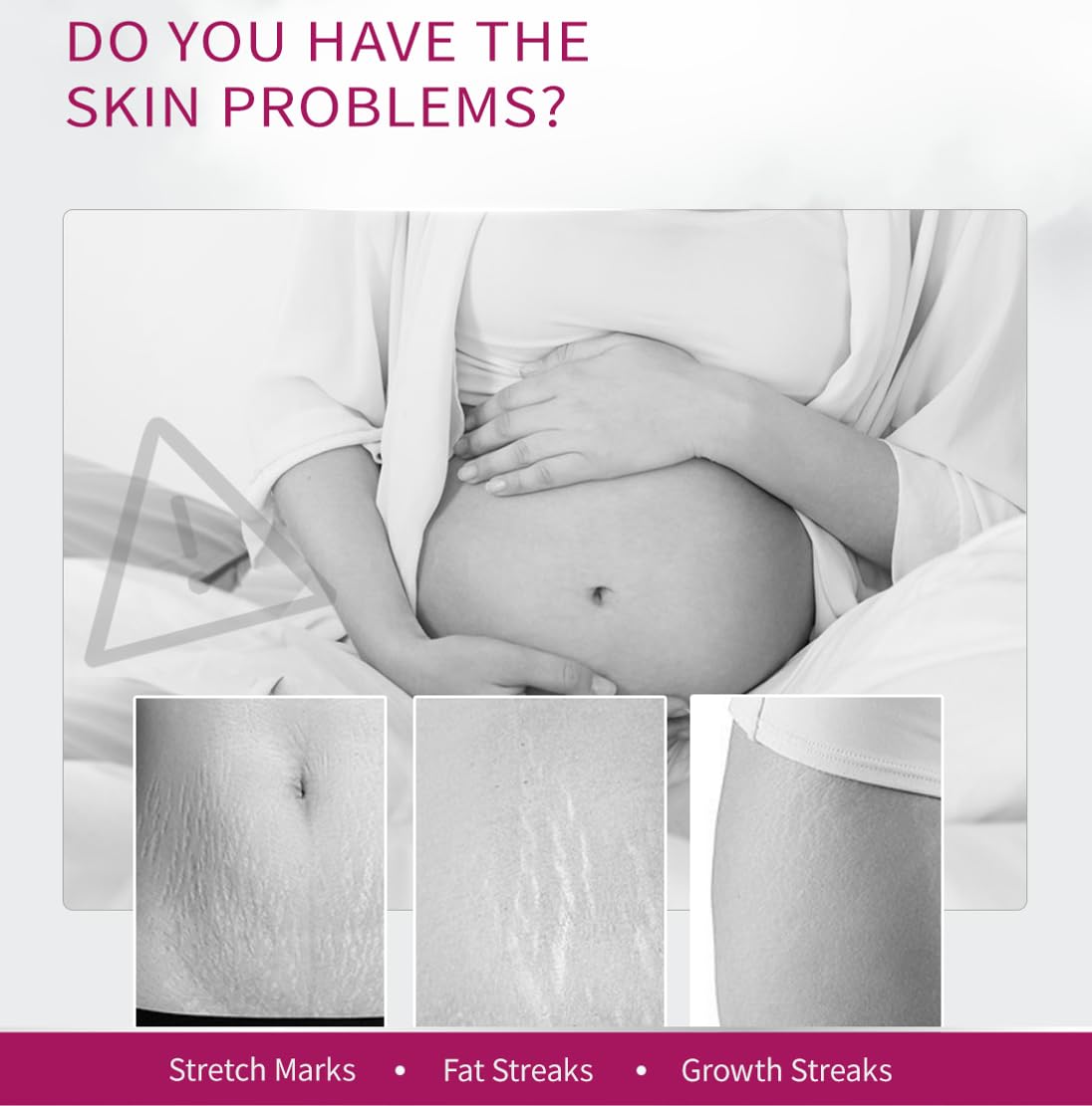 Stretch Mark Removal Cream, Obesity Stretch Mark Moisturizer, Postpartum Repair Stretch Mark Cream, Abdominal Stretch Mark Cream, Remove Marks (1 PCS)