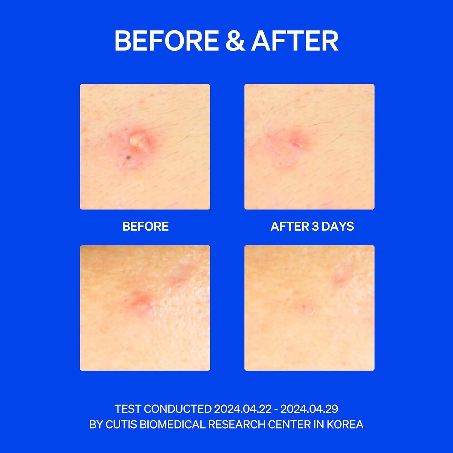 Right Away Thincognito Invisible Spot Patch - Absorbing Hydrocolloid Pimple Patch for Face, Blemishes, Zits, Acne, Breakouts Spot Treatment for Skin Care, 2 Sizes (42 Count Pack of 2)