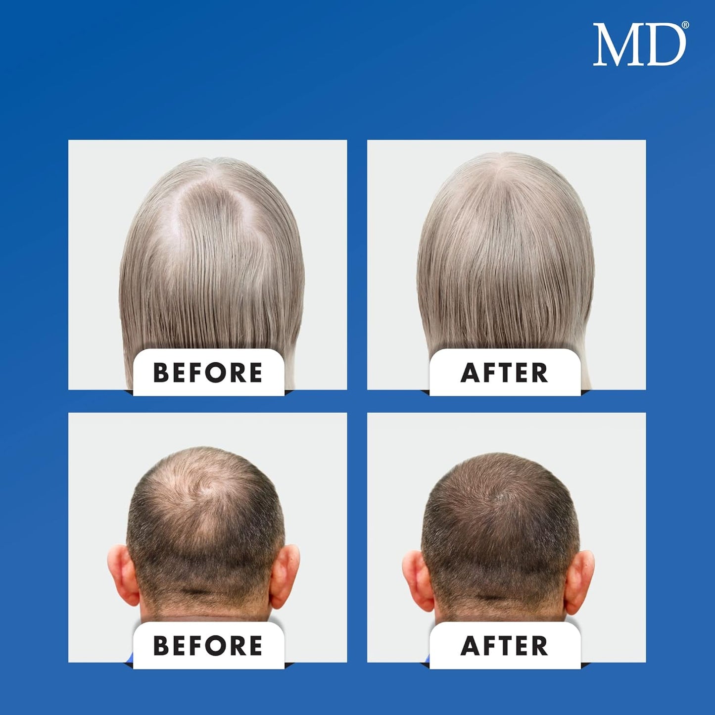 MD Nutri Hair Growth Supplement with Biotin (30 Capsules) | for Hair Loss, Minimizes Hair Shedding, Thinning, Breakage & Promotes Longer, Thicker Hair