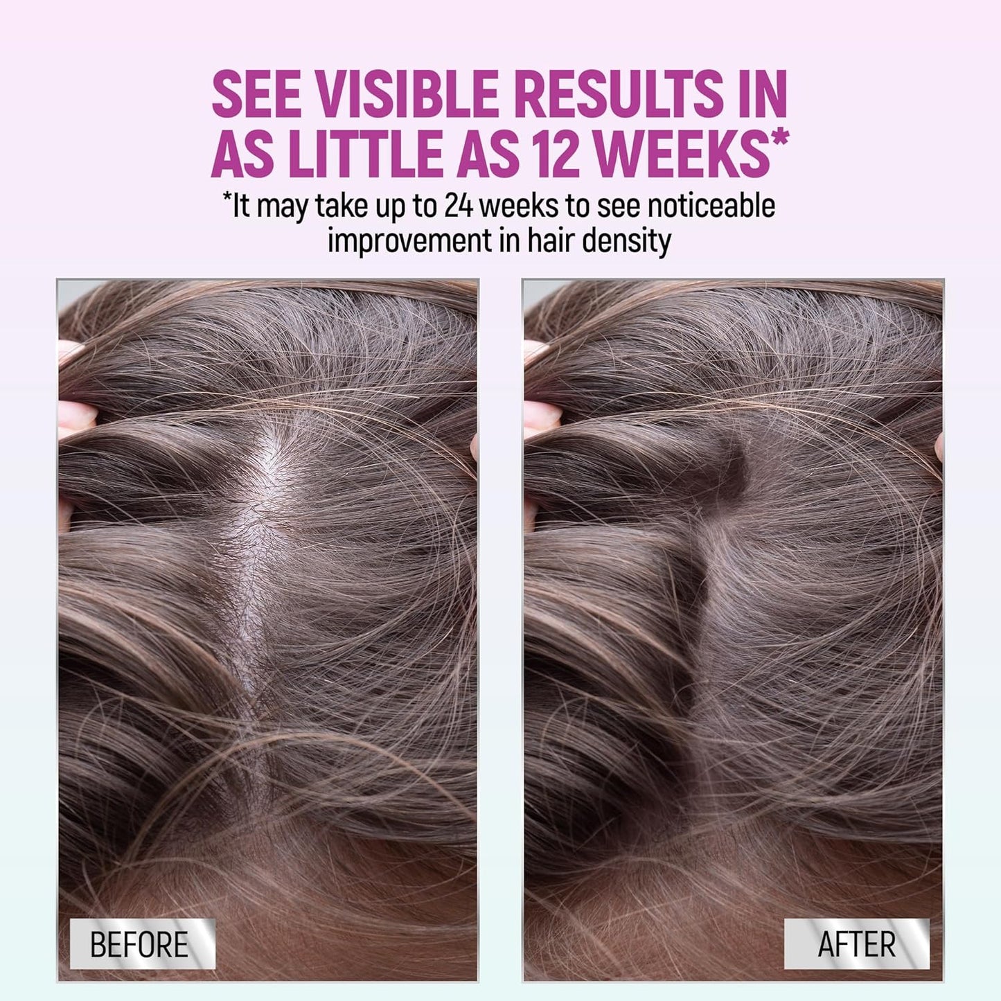 Taro Minoxidil for Women, 2.11 Oz (2 Months Supply) Clinically Proven to Regrow Hair, Topical Aerosol Foam 5%, Hair Thinning Treatment